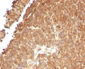IHC testing of FFPE human melanoma with TOP1MT antibody (clone TPIMT-1). Staining of formalin/paraff