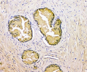 IHC staining of FFPE human prostate cancer with PSA antibody. HIER: boil tissue sections in pH8 EDTA