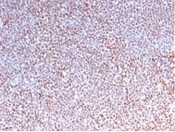 IHC staining of FFPE human anaplastic large cell lymphoma tissue with recombinant Anaplastic Lymphom