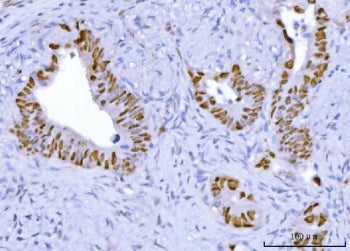 IHC staining of FFPE human colorectal adenocarcinoma tissue with TP53 antibody. HIER: boil tissue se