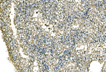 IHC staining of FFPE human renal cell carcinoma tissue with NEDD4 antibody. HIER: boil tissue sectio