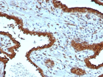 IHC staining of FFPE human prostate tissue with Galectin-3 antibody (clone LGALS3/6583). HIER: boil
