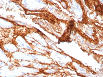 IHC staining of FFPE human prostate carcinoma tissue with Decorin antibody (clone DCN/8760R). HIER: