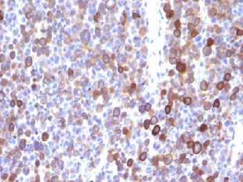IHC testing of FFPE human melanoma with Moesin antibody (clone MSN/491). Required HIER: boil tissue