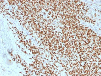 IHC testing of Ewing's sarcoma stained with recombinant NKX2.2 antibody (clone rNX2/1523). Required