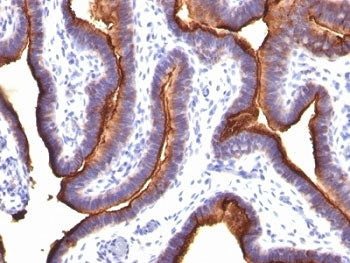 Formalin-fixed, paraffin-embedded human ovarian carcinoma stained with EMA antibody (MUC1/845).