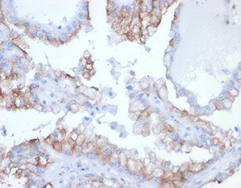IHC staining of FFPE human kidney cancer tissue with recombinant Cdc20 antibody (clone rCDC20/7184)