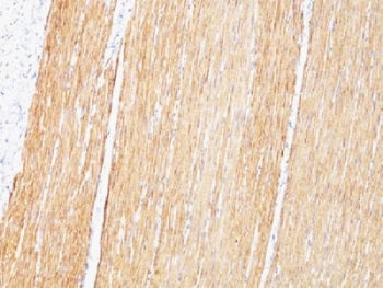 IHC testing of FFPE human leiomyosarcoma with Desmin antibody (clone D33). HIER: boil tissue section