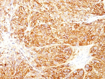 IHC staining of FFPE human melanoma tissue with Melanoma Marker antibody cocktail (clones DT101+ BC1