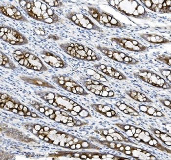 IHC staining of FFPE human rectal cancer tissue with MUC5B antibody. HIER: boil tissue sections in p