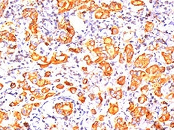 IHC testing of human breast cancer stained with MUC1 antibody (clone GP1.4). Note cytoplasmic and me