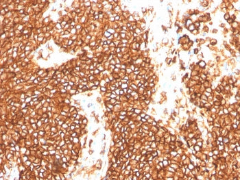 IHC staining of FFPE human Ewings sarcoma with recombinant CD99 antibody (clone MIC2/3478R). HIER: b
