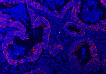 Immunofluorescent staining of FFPE human colorectal adenocarcinoma tissue with TRAM1L1 antibody (red