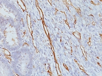 IHC analysis of formalin-fixed, paraffin-embedded human colon carcinoma stained with CD31 antibody (