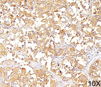 IHC staining of human melanoma (10X) with gp100 antibody (clone HMB45). HIER: boil tissue sections i