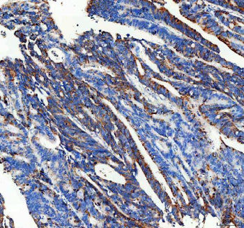 IHC staining of FFPE human colon cancer tissue with CPT2 antibody, HRP-secondary and DAB substrate.
