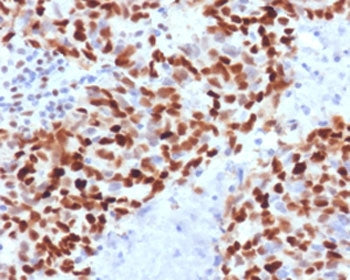 IHC staining of FFPE human colon carcinoma with MSH6 antibody (clone MTS6-1). HIER: boil tissue sect