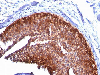 IHC: Formalin-fixed, paraffin-embedded human bladder carcinoma stained with Cytokeratin 17 antibody