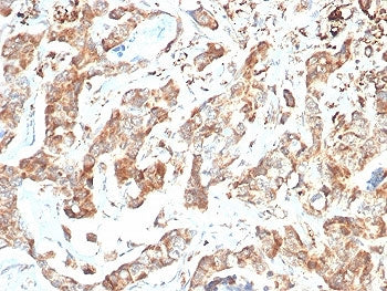 IHC staining of FFPE human colon carcinoma tissue with CD269 antibody (clone BCMA/7254). HIER: boil
