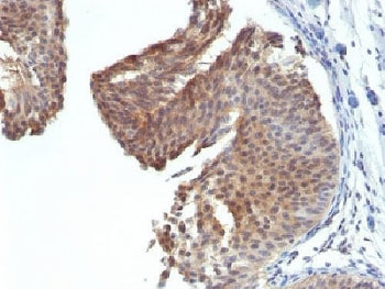 IHC testing of FFPE human bladder carcinoma with Cytokeratin 6 antibody (clone KRT6/1702). Required
