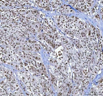 IHC staining of FFPE human bladder cancer tissue with Menin antibody. HIER: boil tissue sections in