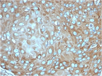 IHC staining of FFPE human skin squamous cell carcinoma with recombinant RPSA antibody (clone rRPSA/