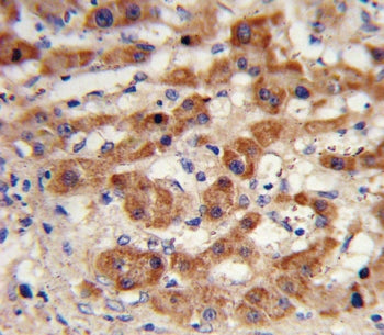 IHC testing of FFPE human hepatocellular carcinoma tissue with NAT antibody. HIER: steam section in