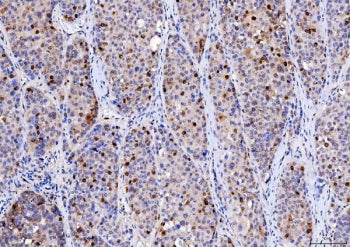 IHC staining of FFPE human liver cancer tissue with CDK2 antibody. HIER: boil tissue sections in pH8