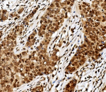 IHC staining of FFPE human breast cancer with TRIM33 antibody. HIER: boil tissue sections in pH8 EDT
