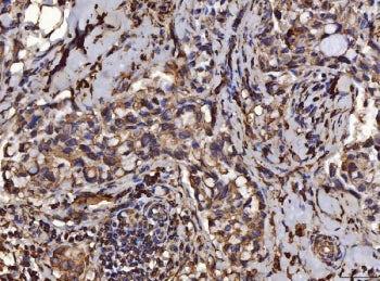 IHC staining of FFPE human breast infiltrating ductal carcinoma tissue with PDIA6 antibody. HIER: bo