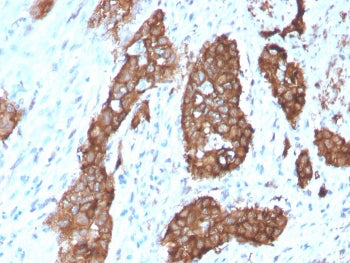 IHC staining of FFPE human breast carcinoma with PDLIM1 antibody (clone CPTC-PDLIM1-1). HIER: boil t