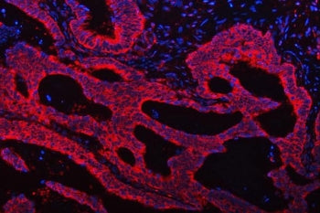 Immunofluorescent staining of FFPE human intestinal cancer tissue with TRMT61B antibody (red) and DA