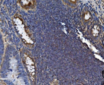 IHC staining of FFPE human rectal cancer tissue with SEC14L3 antibody. HIER: boil tissue sections in