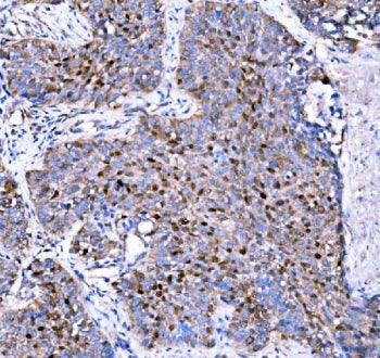 IHC staining of FFPE human lung cancer tissue with p57Kip2 antibody. HIER: boil tissue sections in p