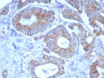 IHC staining of FFPE human colon carcinoma tissue with SDHA antibody (clone SDHA/7491). HIER: boil t