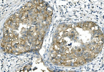 IHC staining of FFPE human breast cancer with BUB1B antibody. HIER: boil tissue sections in pH8 EDTA