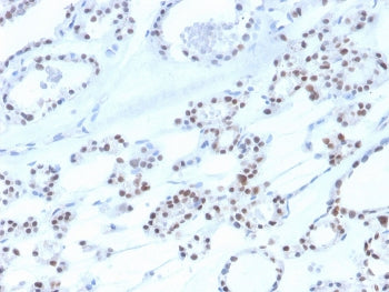 IHC staining of FFPE human thyroid with recombinant PAX8 antibody. HIER: boil tissue sections in pH