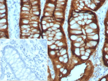IHC staining of FFPE human colon adenocarcinoma with Villin antibody (clone VIL1/8105R). Inset: PBS