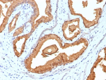 IHC staining of FFPE human prostate carcinoma tissue with Prostate Specific Antigen antibody (clone