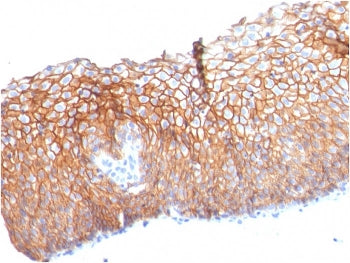IHC staining of FFPE human esophageal carcinoma with Desmoglein 3 antibody (clone DSG3/2840). HIER:
