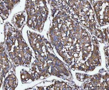 IHC staining of FFPE human liver cancer tissue with TANGO1 antibody. HIER: boil tissue sections in p