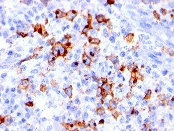 IHC: Formalin-fixed, paraffin-embedded human Hodgkin's lymphoma stained with CD15 antibody (BRA-4F1)