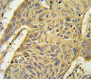 IHC staining of FFPE human lung carcinoma tissue with AGER antibody. HIER: steam section in pH6 citrate buffer for 20 min and allow to cool prior to staining.