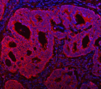Immunofluorescent staining of FFPE human intestinal cancer with TMC7 antibody (red) and DAPI nuclear