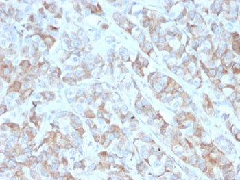 IHC testing of FFPE human gastric carcinoma with BCMA antibody (clone BCMA/2366). HIER: boil tissue