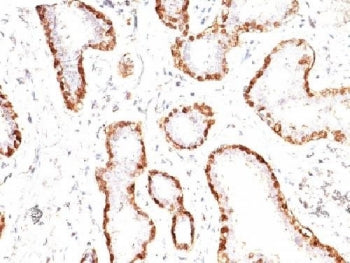IHC: Formalin-fixed, paraffin-embedded human breast carcinoma stained with anti-Calponin antibody (c