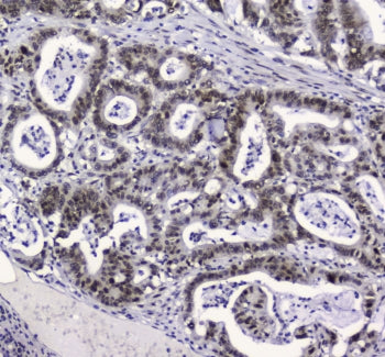 IHC testing of FFPE human intestinal cancer with APE1 antibody at 2ug/ml. HIER: boil tissue sections