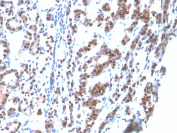 IHC: Formalin-fixed, paraffin-embedded human thyroid stained with recombinant TTF-1 antibody (clone