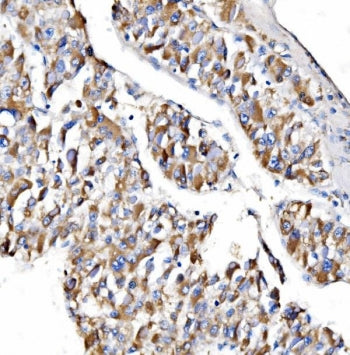 IHC staining of FFPE human liver cancer tissue with NDUFAF1 antibody. HIER: boil tissue sections in