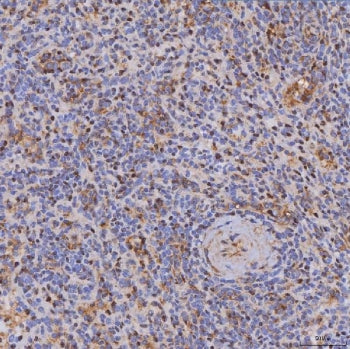 IHC staining of FFPE human spleen cancer tissue with IL2-inducible T-cell kinase antibody. HIER: boi